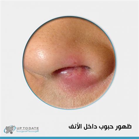 كيف تمنع ظهور هذه الحبوب في الأنف؟