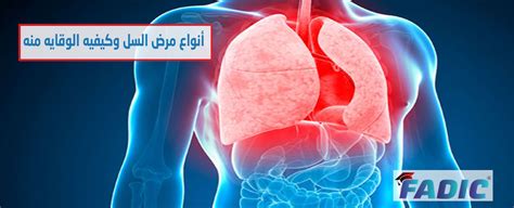 كيف ينتقل مرض السل الكامن من شخص لآخر وما مدى خطورته؟