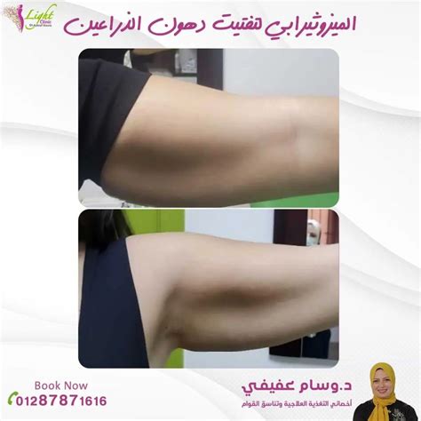 كيفية استخدام حقن الميزوثيرابي لفقدان الوزن