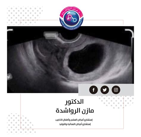 كيفية اكتشاف الحمل مع وجود كيس حمل فارغ