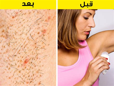 للشعر الذي ينمو تحت الجلد