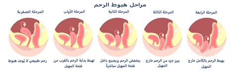 ما الذي يتم أثناء تطهير الرحم وتوسيعه؟