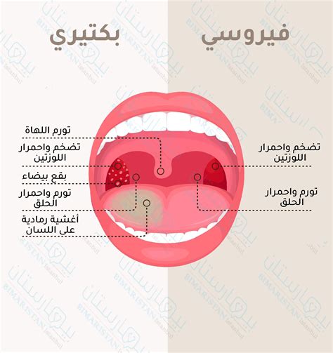 ما الذي يسبب التهاب اللوزتين؟