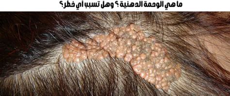 ما الذي يسبب الوحمة؟
