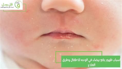 ما الذي يسبب بقع بيضاء على الوجه عند الرضع