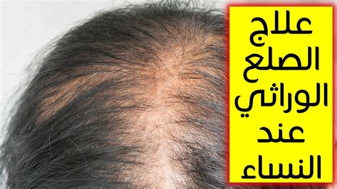 ما الذي يسبب تساقط الشعر الوراثي؟