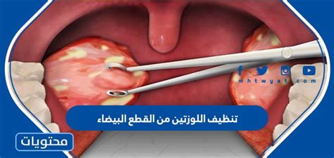 ما الذي يسبب ظهور بقع بيضاء على اللوزتين بدون ألم