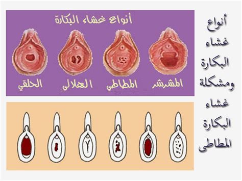 ما الذي يسبب غشاء البكارة الرتق ما الذي يسبب غشاء البكارة الرتق