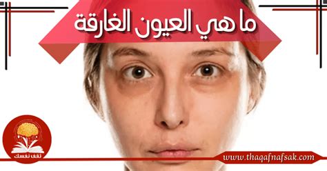 ما الذي يسبب مشكلة العيون الغارقة؟ ما الذي يسبب مشكلة العيون الغارقة؟