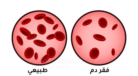 ما الذي يمكنك فعله للوقاية من فقر الدم