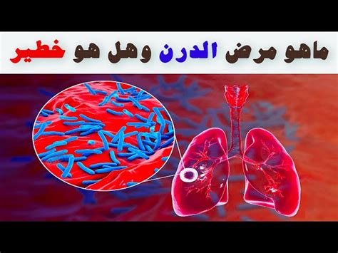 ما هو تشخيص المصابين باضطرابات ذهانية وهل هو خطير