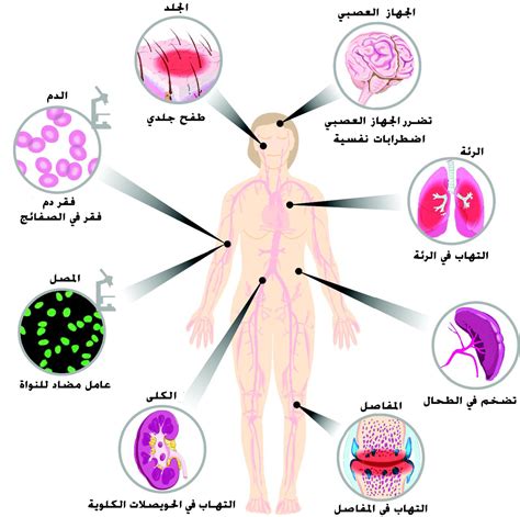 ما هي إجراءات تشخيص الذئبة الحمامية؟