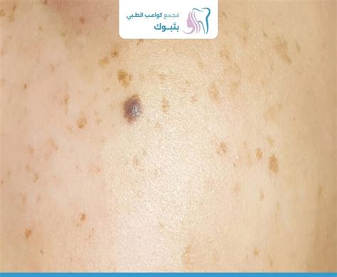 ما هي العوامل والأسباب التي تؤدي إلى ظهور البقع الداكنة؟ ما هي العوامل والأسباب التي تؤدي إلى ظهور البقع الداكنة؟
