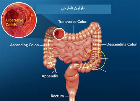 ماذا يمكنني أن أفعل للوقاية من التهاب القولون التقرحي؟