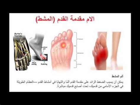 متابعة أسباب ألم مشط القدم من أعلى المرأة الحامل