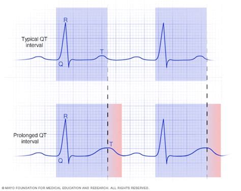 متلازمة فترة QT الطويلة