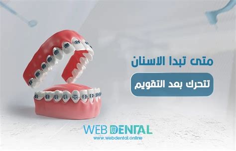 متى تبدأ الأسنان بالحركة بعد التقويم في رأي الأطباء؟