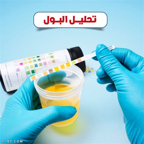 متى يتم إجراء اختبار تحليل البول للكشف عن الخلايا الظهارية؟