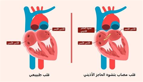مضاعفات عيب الحاجز الأذيني