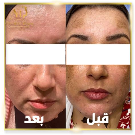 من الذي لا يجب أن يحصل على التقشير الكيميائي؟