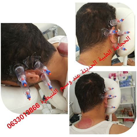 مواقع الحجامة لالتهاب الأذن الوسطى