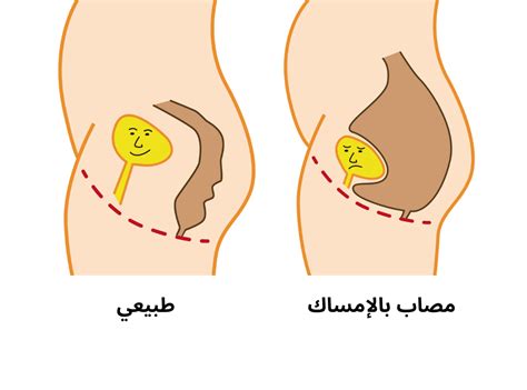 نصائح للأشخاص الذين يعانون من فتق في البطن نصائح للأشخاص الذين يعانون من فتق في البطن