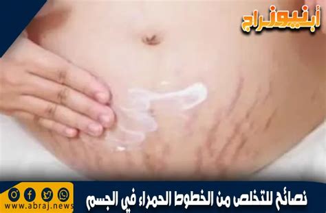 نصائح للتخلص من الخطوط الحمراء في الفخذين