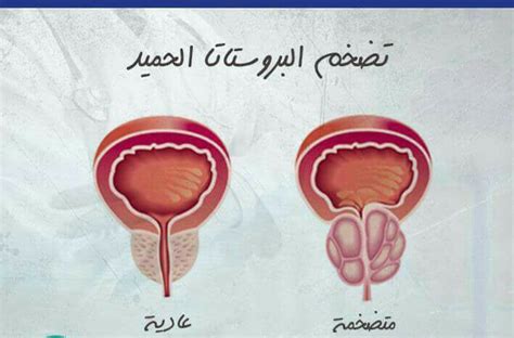 نمط حياة صحي مع مريض يعاني من تضخم البروستاتا الحميد