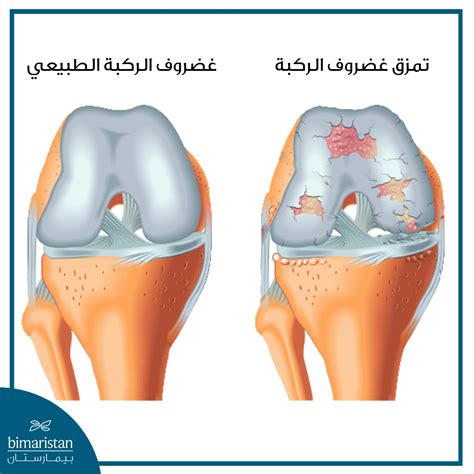 نوع التخدير الثاني لجراحة غضروف الركبة