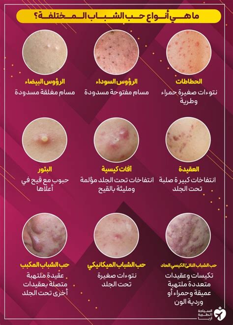 هذه هي أهم الإجراءات لمنع ظهور البثور تحت الجلد في المناطق الحساسة: