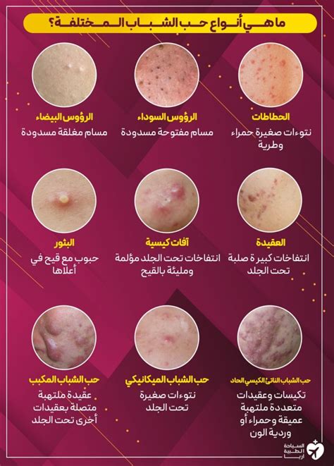 هذه هي الأسباب الرئيسية التي يمكن أن تؤدي إلى ظهور بثور تحت الجلد في الأنف: