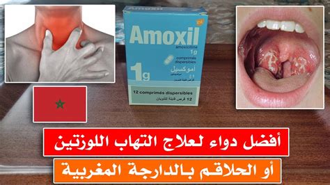 هل المضادات الحيوية فعالة في علاج جميع أنواع التهاب الحلق عند الأطفال؟