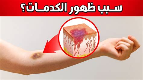 هل تفسر إصابة الأنسجة الداخلية بدون قطع في الجلد يسمى قرحة؟