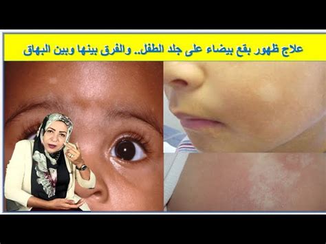 هل نقص الفيتامينات يسبب ظهور بقع بيضاء على الوجه عند الأطفال؟