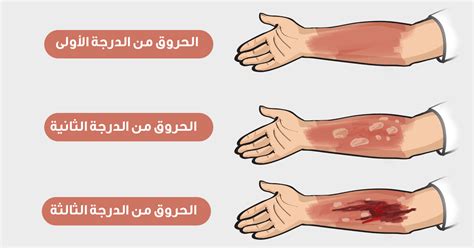 هل هناك اختلاف في مراحل الشفاء من درجات مختلفة من الحروق؟ هل هناك اختلاف في مراحل الشفاء من درجات مختلفة من الحروق؟