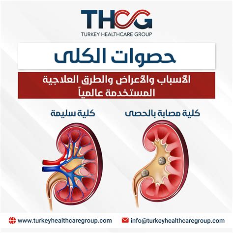 هناك بعض الحقائق العلمية التي يجب التوقف عنها لعلاج حصوات الكلى والمثانة مثل: