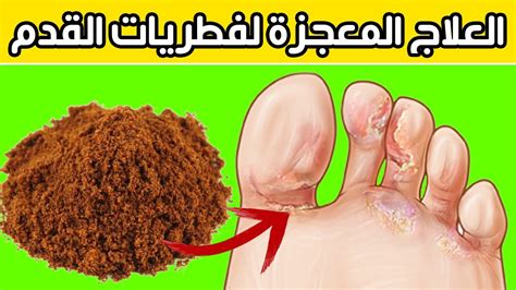 وصفات يمكنك صنعها في المنزل لعلاج الفطريات بين أصابع القدم. وصفات يمكنك صنعها في المنزل لعلاج الفطريات بين أصابع القدم.