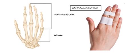 يتم إصلاح إجابة السؤال حول أسباب الإصبع المكسور بالإصبع المجاور له