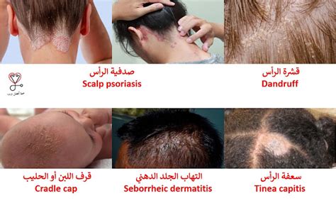 يكمن الاختلاف بين الصئبان وقشرة الرأس في سهولة الإزالة