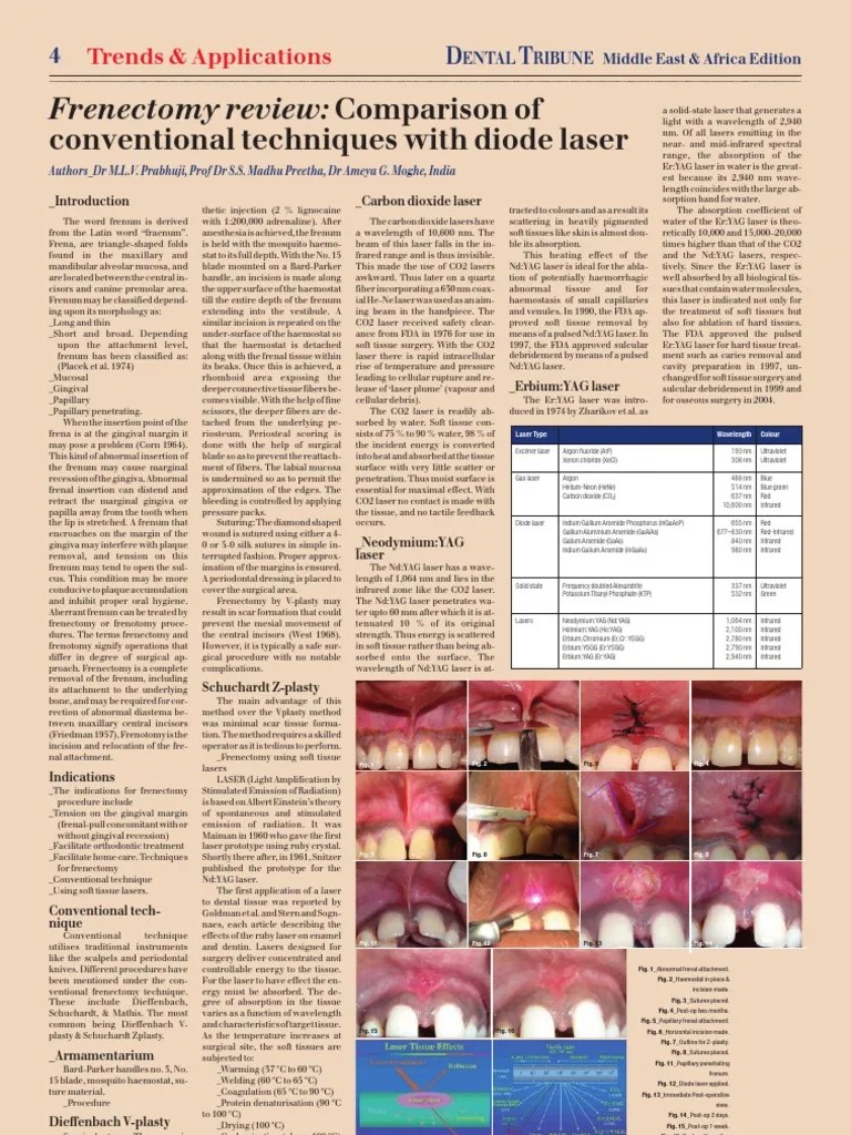 Frenectomy PDF Laser Infrared