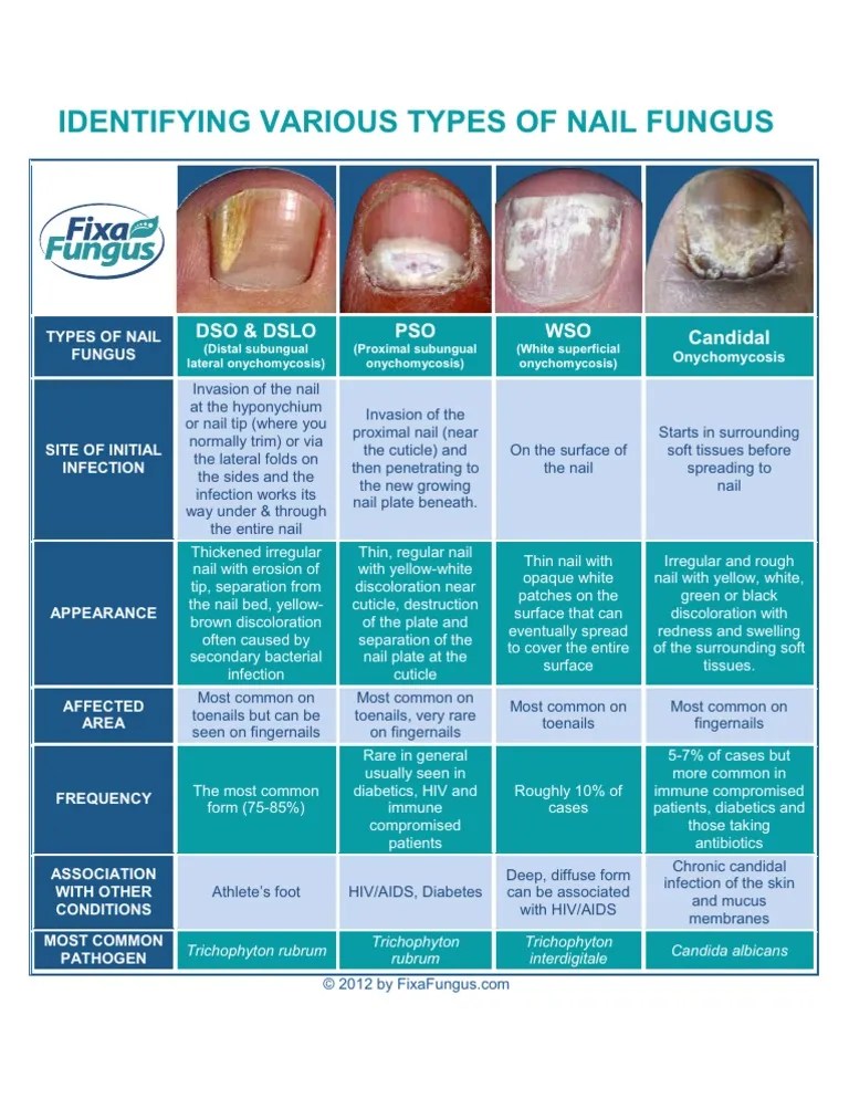 Identifying Types of Nail Fungus