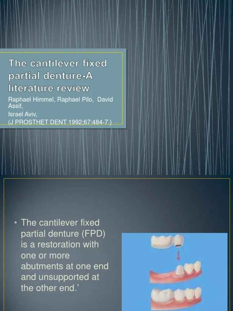 The Cantilever Fixed Partial DentureA Literature Review Human Tooth