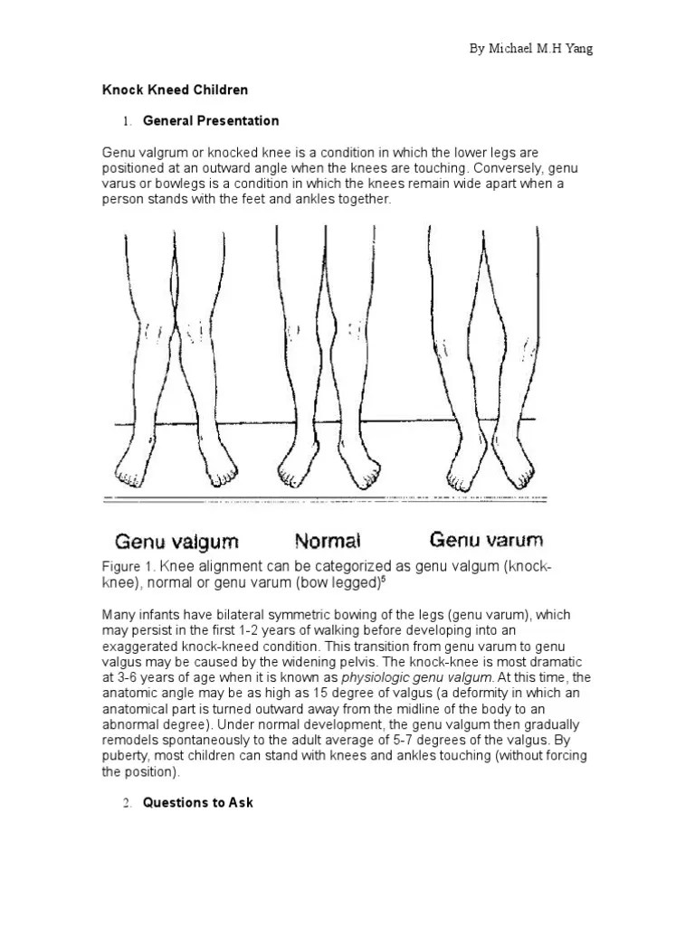 Knock Kneed Children Knee Alignment Can Be Categorized As Genu Valgum