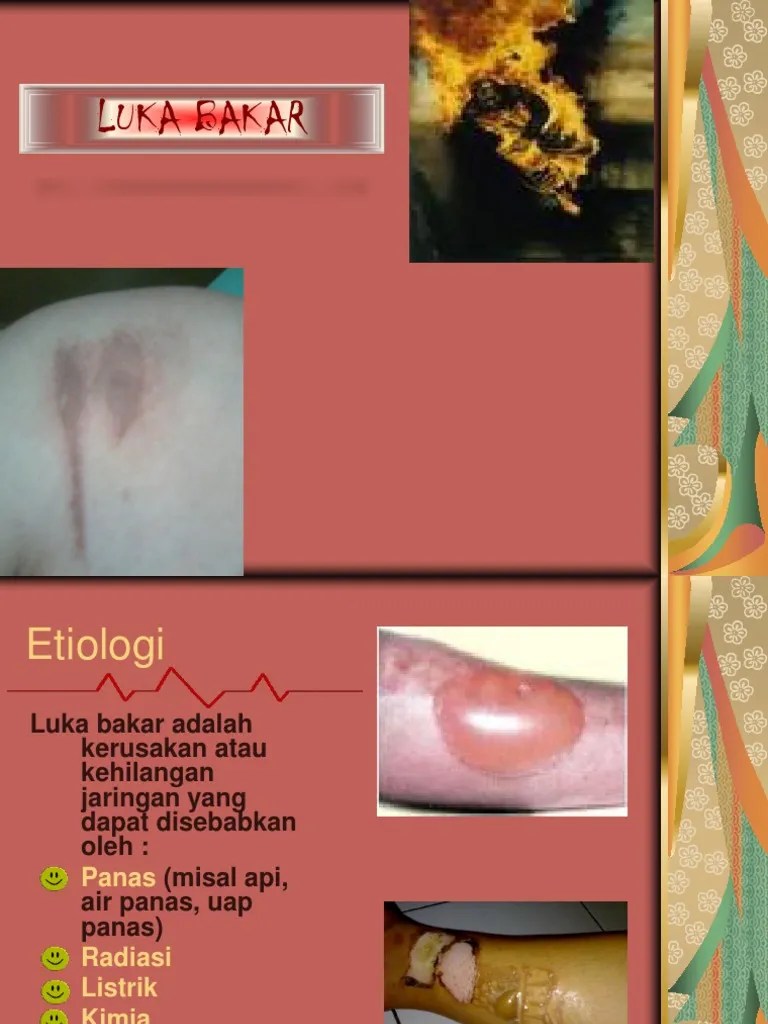 Swamedikasi Slide Luka Bakar