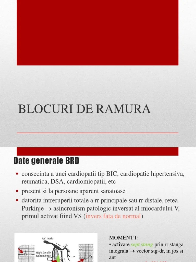 EKG BRD BRS IV