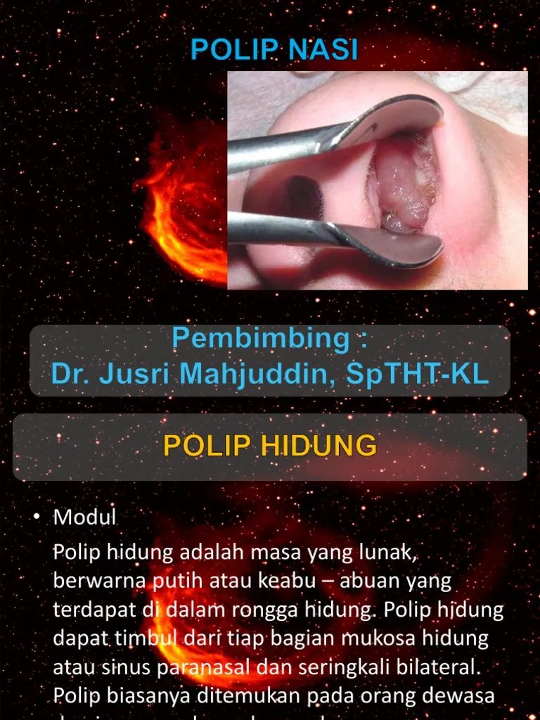 Polip Nasi | PDF