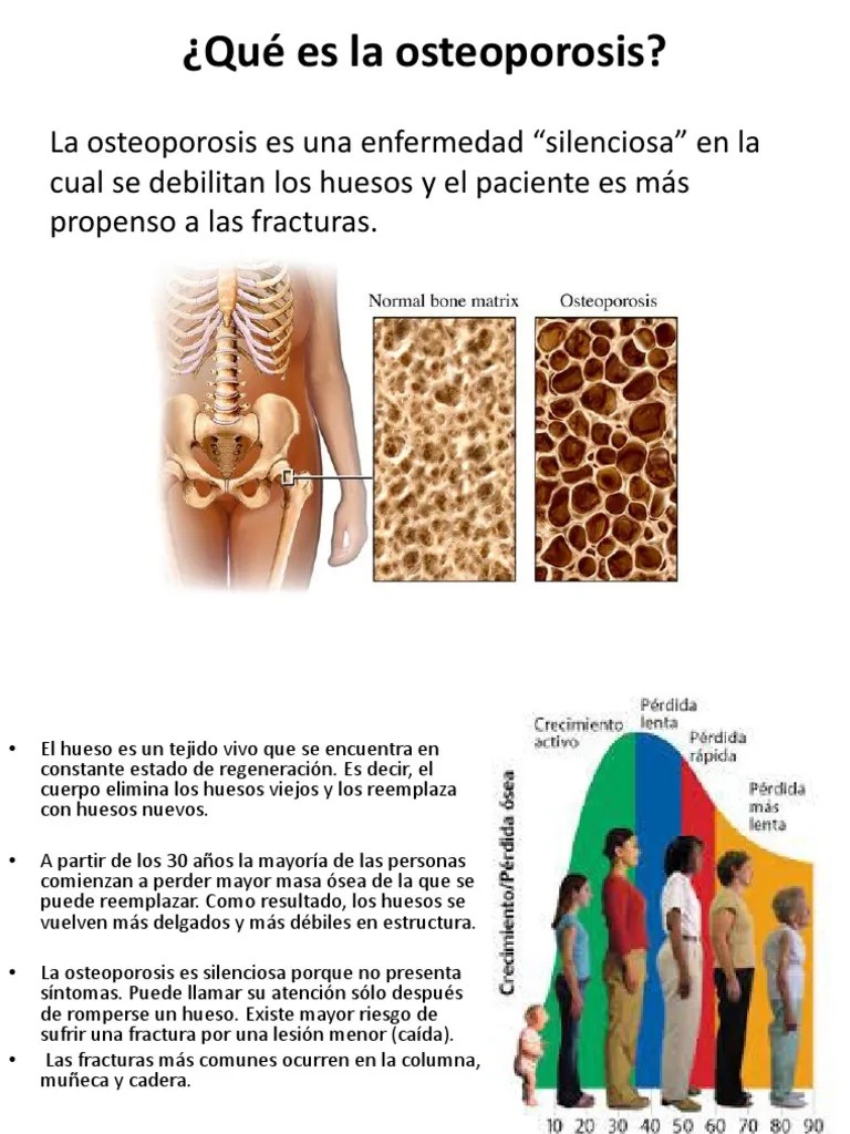 Qué es la osteoporosis Osteoporosis Hueso