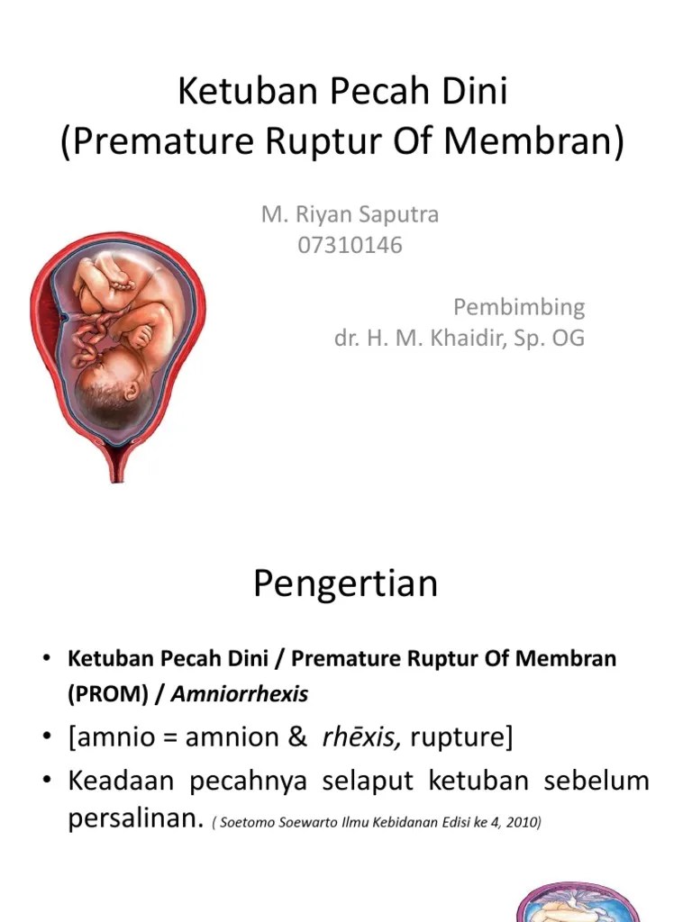Ketuban Pecah Dini PPT