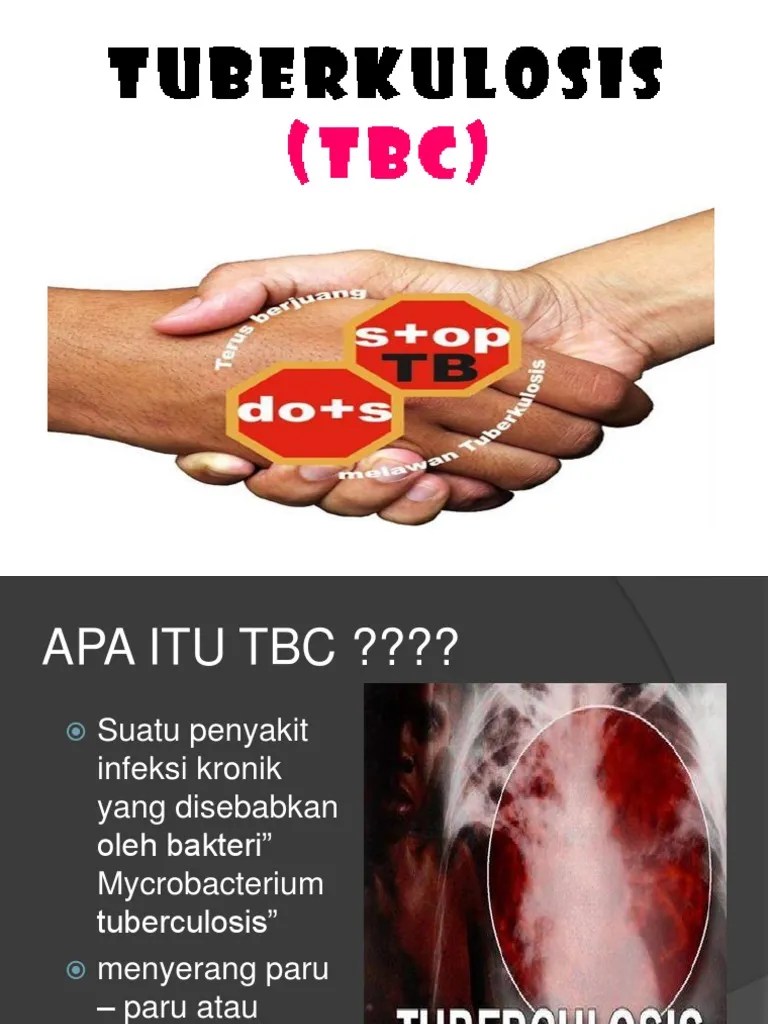 PENYULUHAN TBC