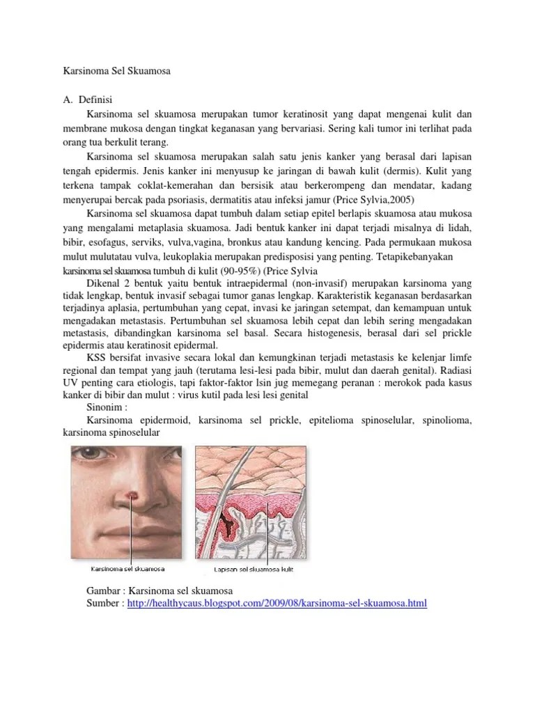 Karsinoma Sel SkuamosaA | PDF